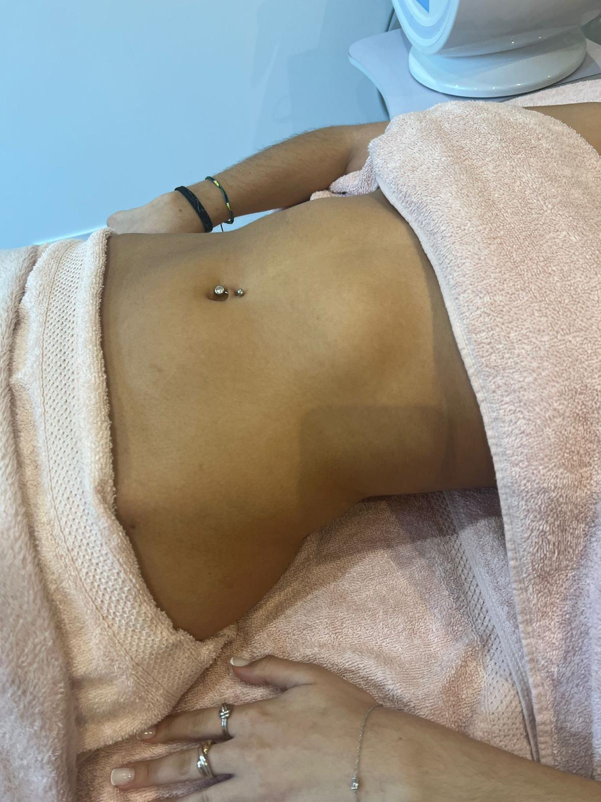 Sonia - avant le drainage lymphatique