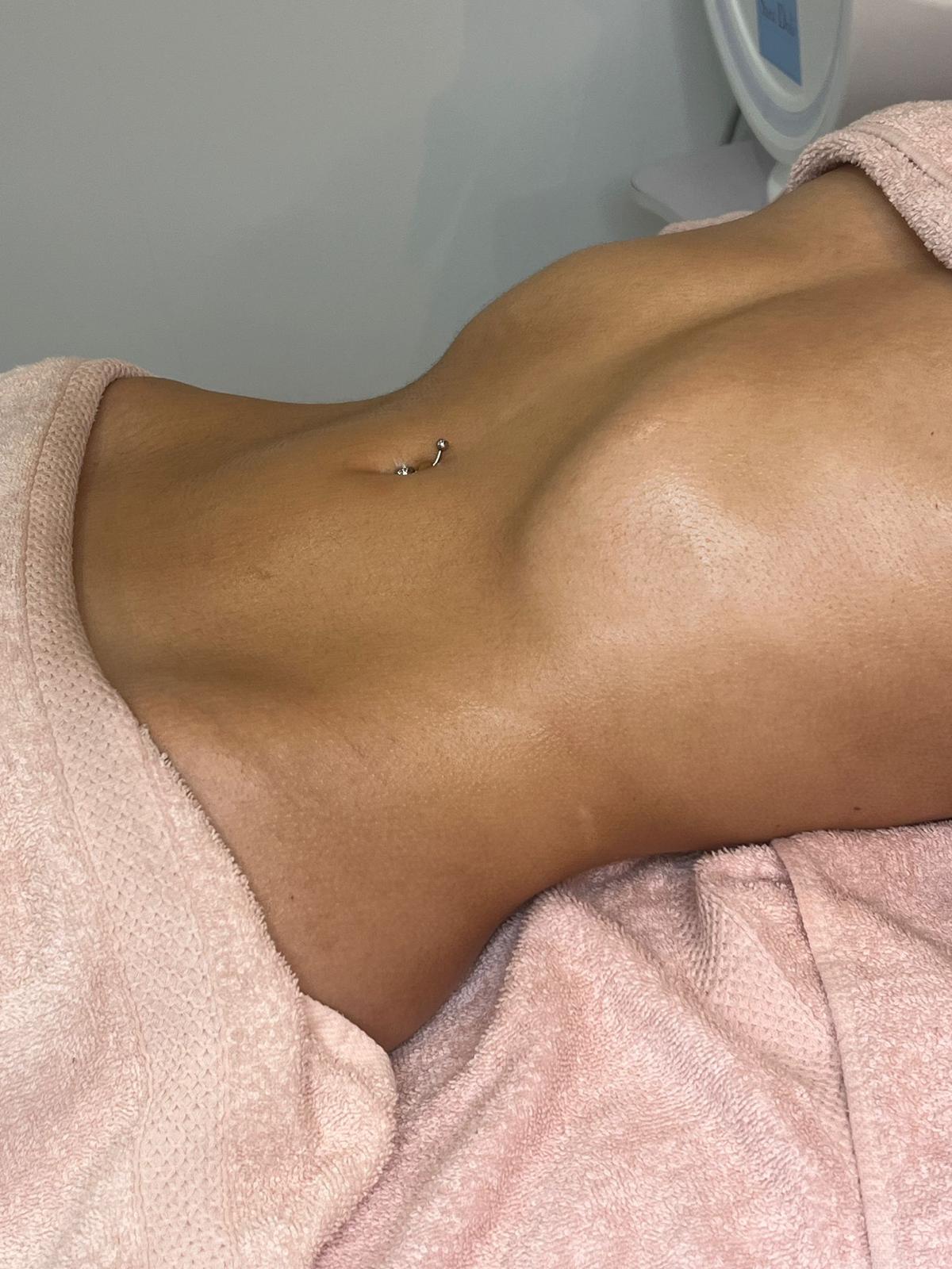 Sonia - après le drainage lymphatique